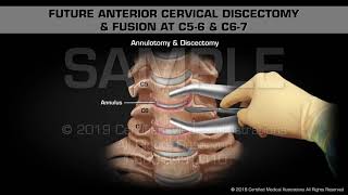 Future Anterior Cervical Discectomy amp Fusion at C56 amp C67  Medical Animation [upl. by Aihseket]