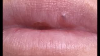 Relaxing Lips Blackheads Extraction Tiktok Compilation 10 [upl. by Husein]