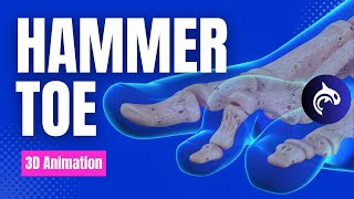 Hammer Toe Condition Treatment and Surgery  3D Animation [upl. by Demahum]