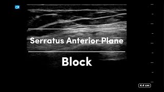 Serratus Anterior Plane Block [upl. by Sotnas]