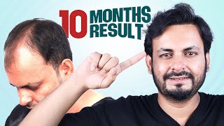 10Month Results 4800 Grafts 😍  Hair Transplant in Bangladesh  New Roots [upl. by Shane989]