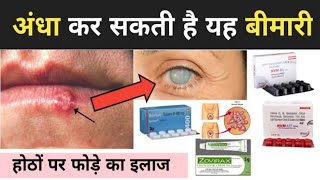 What is Herpes simplex Herpes Treatment in Hindi 👈 हर्पीज़ के कारण 👈 होठों पर फोड़े का इलाज 👈 Medic [upl. by Slein670]