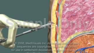 Thoracotomy  Normal Procedure [upl. by Arocat]