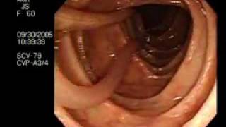 Worm Intestine Ascariasis [upl. by Droffig959]