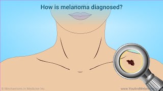 Diagnosing Melanoma [upl. by Franciskus]