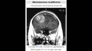 Glioblastoma Multiforme grade IV astrocytoma  Most Common Primary Brain Tumor [upl. by Mckay]