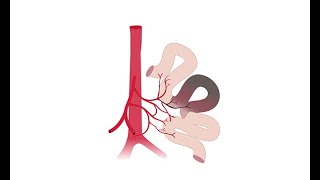 Recognizing acute mesenteric ischemia [upl. by Yim114]