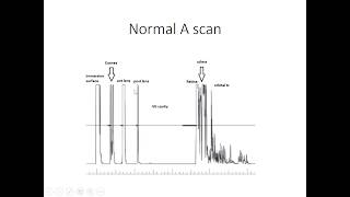 Ophthalmic Ultrasound Part 1 [upl. by Peddada]