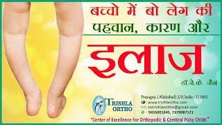 Physiological Bow Leg Causes Identification amp Treatment बो लेग की पहचान कारण और इलाज  Trishla [upl. by Artemas107]