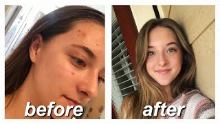 ACCUTANE FOR MILD ACNE  my story amp monthly updates [upl. by Akienom183]