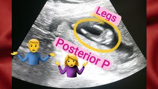 13 weeks oregnant gender reveal  posterior placenta means baby boygirl  how to tell gender on usg [upl. by Acemat]