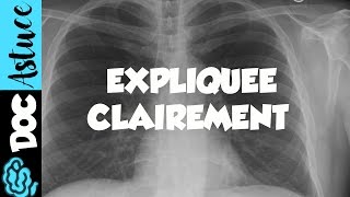 🔴 Dr Astuce  3 ANOMALIES RADIO THORAX EXPLIQUÉES CLAIREMENT  PARTIE 1 [upl. by Dodson]