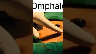 Umbilical granulomaAbscess viralvideo hospital viralshort viralvideos tranding [upl. by Eirual169]