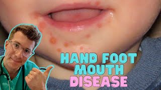 How to recognise amp treat Hand Foot and Mouth Disease Coxsackievirus in kids  Doctor ODonovan [upl. by Ayanet895]