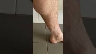 These Calf Muscle Twitches Cramps and Spasms Look Like Little Earthquakes Under the Skin [upl. by Kerman]