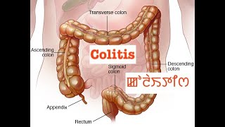 Colitis ꯀꯣꯂꯥꯏꯇꯤꯁ [upl. by Player635]