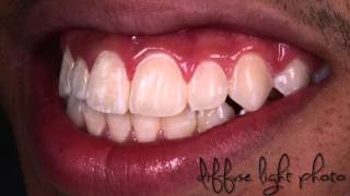 Resin infiltration for esthetic treatment of fluorosis [upl. by Arrait187]