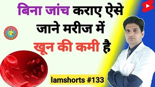 बिना जांच कराए ऐसे जाने मरीज में खून की कमी है  Anemia Shorts lamshorts [upl. by Rodmun340]