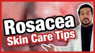 5 Quick Ways to Get Rid of Rosacea FAST  How to Get Rid of Rosacea 2021 [upl. by Atir]