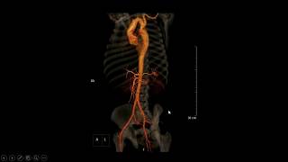 Coarctação da aorta [upl. by Annayi]