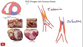 Myocardial ischemia amp infarction  STEMI NSTEMI Q wave infarction Wellens syndrome [upl. by Harutek]