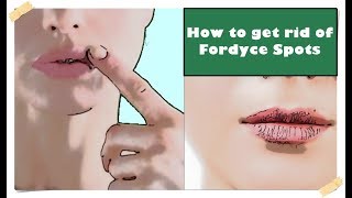 Fordyce Spots on Lips – Treatment How to get rid of them [upl. by Ardiekal]