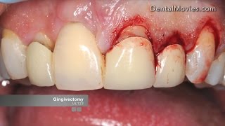 Crown lengthening  Satelec Piezotome 2 [upl. by Jacquenette958]