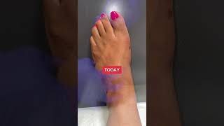 Before amp After AMI Bunion Surgery and Range of Motion [upl. by Saerdna]