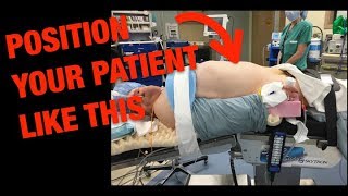 Robotic Right Colectomy Patient Positioning 101 [upl. by Adnuahsal803]