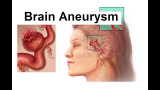 Brain Aneurysm Pathology  Etiology  Pathogenesis  Clinical manifestations  Diagnosis amp Treatment [upl. by Okimuy]