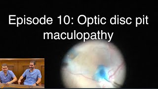 Retina Chats Episode 10 Optic disc pit maculoapthy [upl. by Tarryn]