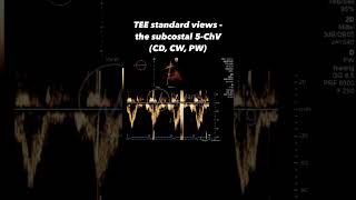 TEE standard  deep transgastric 5ChV the ascending aorta CD amp PW [upl. by Teahan342]