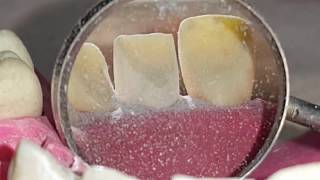 Anterior teeth preparation  U1 by  Ahmed Adnan Albhaisi [upl. by Aros99]