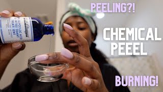 At Home Chemical Peel on Black Skin  Esthetician Approved [upl. by Adnowat]