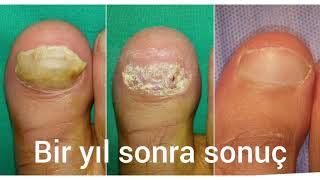 İleri Tırnak Mantarı Tedavisi Advanced Nail Fungus Treatment Istanbul [upl. by Irik]