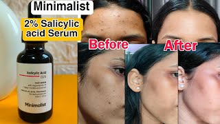 Minimalist 2 Salicylic acid Face Serum  My Honest Review  How I cleared my Skin✅ [upl. by Nedle]