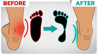 How to Correct Overpronation Fallen Arches [upl. by Aryaz]