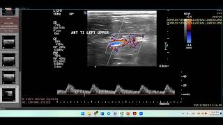 Thromboangitis ObliteransHow to ThinkDoppler Ultrasound Case [upl. by Novaelc]