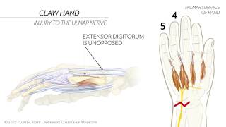 Claw Hand Ape Hand and the Sign of Benediction Animated Review [upl. by Gabriellia]