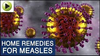 Skin Care  Measles  Natural Ayurvedic Home Remedies [upl. by Nawtna]