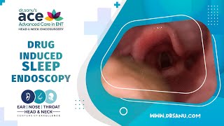 Drug Induced Sleep Endoscopy DISE  To detect site of airway collapse in Obstructive Sleep Apnea [upl. by Ennaj]