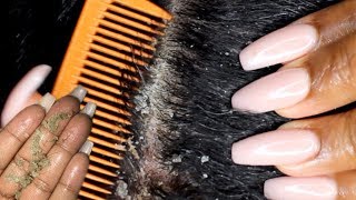 Scalp scratching and picking  Satisfying Dandruff Removal ASMR  Psoriasis [upl. by Orel]