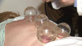 What are the health benefits of cupping [upl. by Atirak]