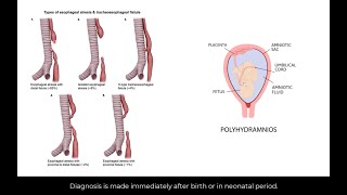 Types of esophageal atresia and tracheoesophageal fistula [upl. by Nnylirak473]