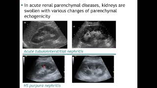 Ultrasound of renal parenchymal diseases [upl. by Mariellen]