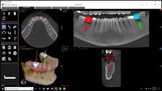 Carestream 3D Imaging  Cross Section Tool [upl. by Aicil]