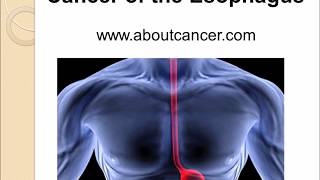 Esophagus Cancer [upl. by Inaleon]