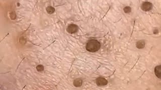 Blackheads amp Whiteheads Satisfying Removal 0116 [upl. by Berners428]