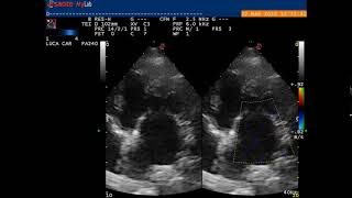 Mitral valve disease timeline of a degenerative condition in dogs [upl. by Aiekram994]