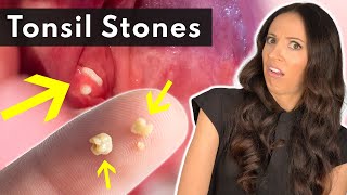 What Are Tonsil Stones amp How To SAFELY Remove Them [upl. by Nyrol]